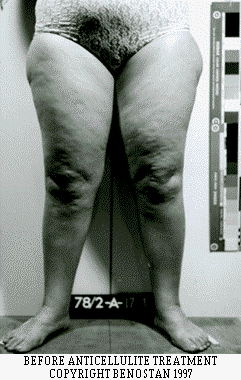 BEFORE CELLULITE TREATMENT